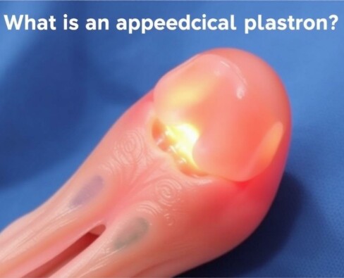 Plastrón apendicular: qué es y cómo manejarlo inicialmente sin cirugía