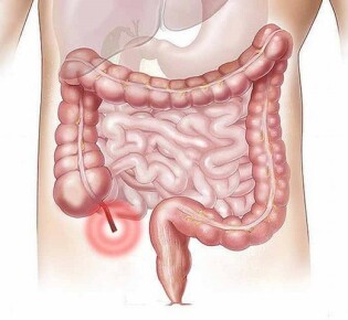 Хронический калькулезный холецистит: что это и как с этим бороться?