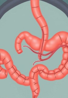 Understanding Appendicitis and Fistula Formation: What You Need to Know