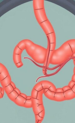 Understanding Appendicitis and Fistula Formation: What You Need to Know
