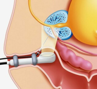 В каких случаях необходимо делать УЗИ предстательной железы?