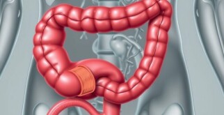 L’obstruction appendiculaire : cause principale de l’appendicite