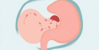 Understanding Wound Infection After Appendectomy: Causes, Prevention, and Care