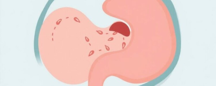 Understanding Wound Infection After Appendectomy: Causes, Prevention, and Care