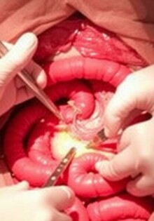 Cirugía abierta (laparotomía) para apendicitis: qué es, por qué se hace y qué esperar