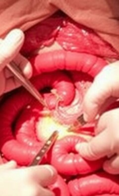 Cirugía abierta (laparotomía) para apendicitis: qué es, por qué se hace y qué esperar