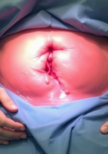 Lavado peritoneal en caso de perforación: cuándo, por qué y qué esperar