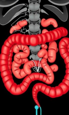 Apendicitis en mujeres: cómo distinguirla de los problemas ginecológicos y no perder tiempo