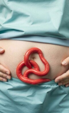 Appendicitis and Obesity: Exploring the Connection and Understanding the Risks