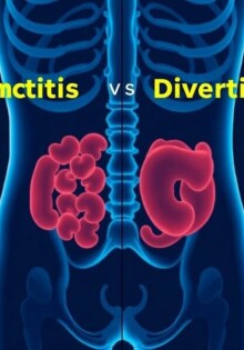 Diferencia entre apendicitis y diverticulitis: cómo reconocer, diagnosticar y tratar dos causas comunes de dolor abdominal