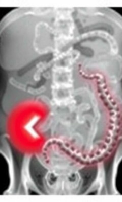 Appendicite Perforée : Urgence Médicale Absolue