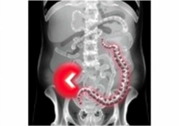 Appendicite Perforée : Urgence Médicale Absolue