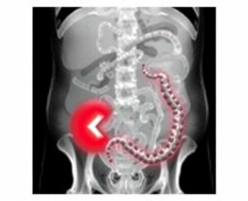 Appendicite Perforée : Urgence Médicale Absolue
