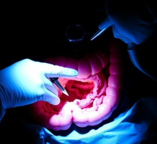 Der Umgang mit einer bereits perforierten Appendizitis: guía práctica y humana