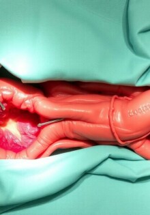 Apendicectomía con incisiones mínimas (NOTES): la cirugía que entra por la puerta natural