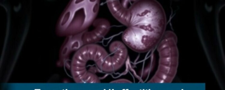 Infecciones parasitarias y apendicitis en zonas endémicas: lo que el médico, el paciente y la comunidad deben saber