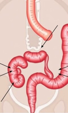 Les signes cliniques classiques de l’appendicite aiguë : reconnaître l’urgence avant qu’il ne soit trop tard