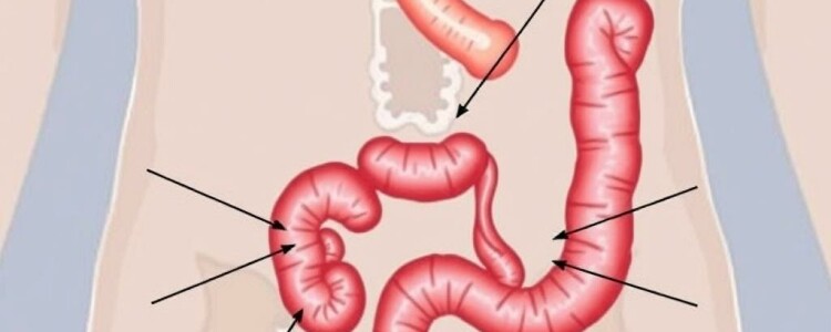 Les signes cliniques classiques de l’appendicite aiguë : reconnaître l’urgence avant qu’il ne soit trop tard