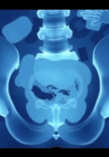 Les formes atypiques de l’appendicite (rétro-caecale, pelvienne): una guía clara y cercana