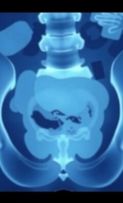 Les formes atypiques de l’appendicite (rétro-caecale, pelvienne): una guía clara y cercana