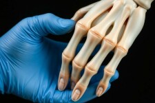 Эндопротезирование мелких суставов кистей