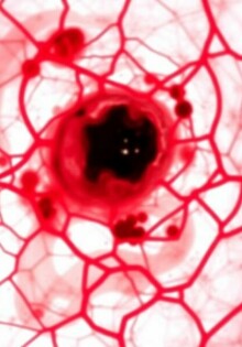 Le granulome à corps étranger (fístula crónica): entender lo que el cuerpo no quiere olvidar