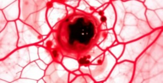 Le granulome à corps étranger (fístula crónica): entender lo que el cuerpo no quiere olvidar