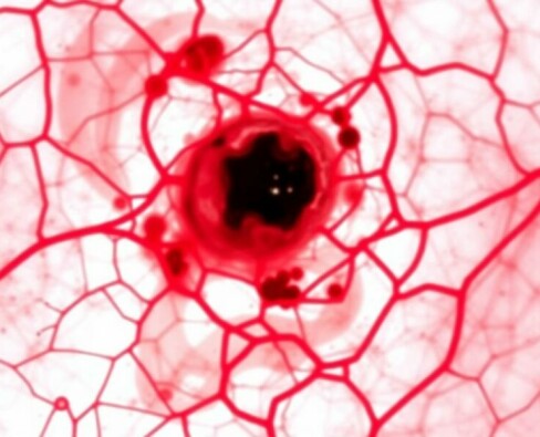 Le granulome à corps étranger (fístula crónica): entender lo que el cuerpo no quiere olvidar