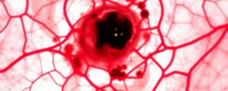 Le granulome à corps étranger (fístula crónica): entender lo que el cuerpo no quiere olvidar