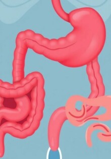 Cuando el apéndice habla: L’appendicite et la maladie de Crohn — entender dos procesos que a veces se confunden
