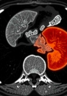 Inteligencia artificial en el diagnóstico por tomografía de la apendicitis: cómo la máquina está aprendiendo a leer el dolor