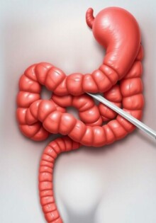 Appendectomy: Surgical Removal of the Appendix Explained