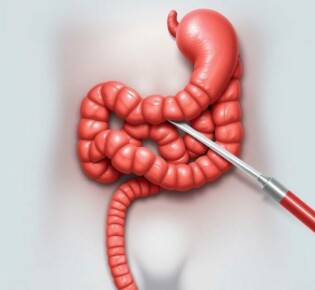 Appendectomy: Surgical Removal of the Appendix Explained