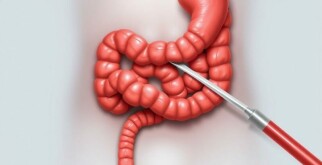Appendectomy: Surgical Removal of the Appendix Explained