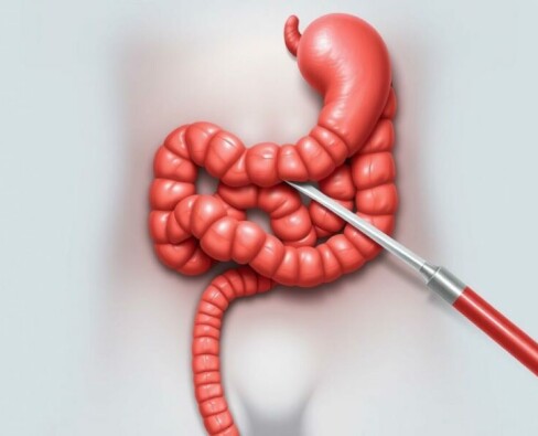 Appendectomy: Surgical Removal of the Appendix Explained
