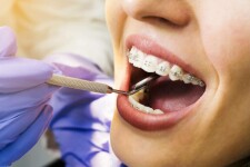 Особенности ортодонтии в стоматологии
