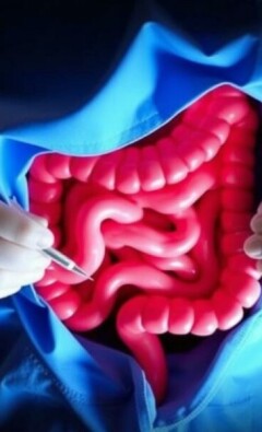 La «Interval Appendectomy»: ¿Por qué a veces la cirugía espera y la medicina actúa primero?