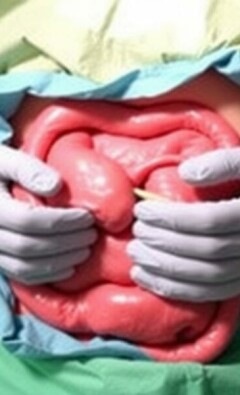Agujeros pequeños, grandes cambios: Todo sobre la apendicectomía laparoscópica