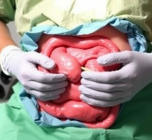 Agujeros pequeños, grandes cambios: Todo sobre la apendicectomía laparoscópica