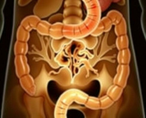 L’appendicite perforée: causas, consecuencias y cómo entender lo que sucede en tu cuerpo