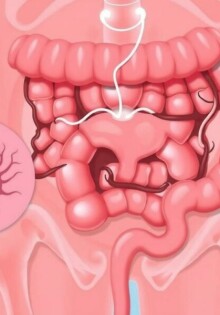 Diferencial diagnóstico: condiciones que imitan una apendicitis (por ejemplo, quistes ováricos, gastroenteritis)