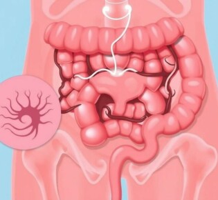 Diferencial diagnóstico: condiciones que imitan una apendicitis (por ejemplo, quistes ováricos, gastroenteritis)