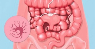 Diferencial diagnóstico: condiciones que imitan una apendicitis (por ejemplo, quistes ováricos, gastroenteritis)