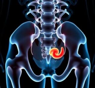 Мочекаменная болезнь: Полное руководство по профилактике для здоровья почек