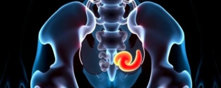 Мочекаменная болезнь: Полное руководство по профилактике для здоровья почек