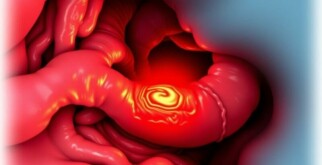Understanding Appendiceal Abscess: Causes, Symptoms, and Treatment Explained