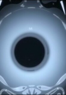 MRI for Appendicitis in Pregnancy: A Safe and Effective Diagnostic Tool