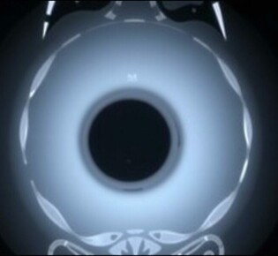 MRI for Appendicitis in Pregnancy: A Safe and Effective Diagnostic Tool