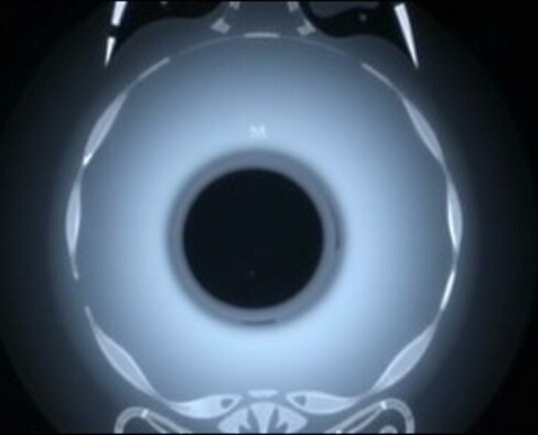 MRI for Appendicitis in Pregnancy: A Safe and Effective Diagnostic Tool