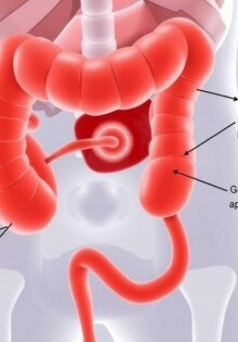 Differenzialdiagnosen der Blinddarmentzündung: Wenn der Bauch schmerzt, aber es nicht der Blinddarm ist